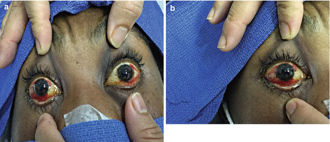 Jamaica Declares Leptospirosis Outbreak After Hurricane Melissa